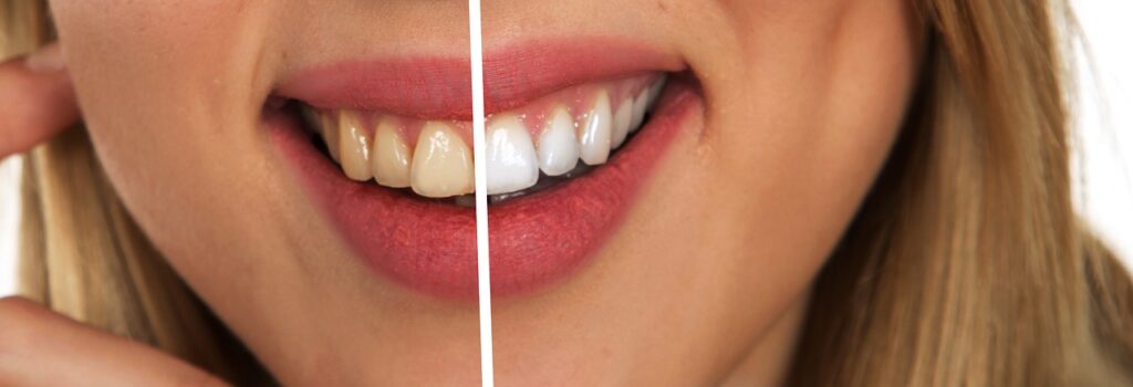 coconut oil pull before after