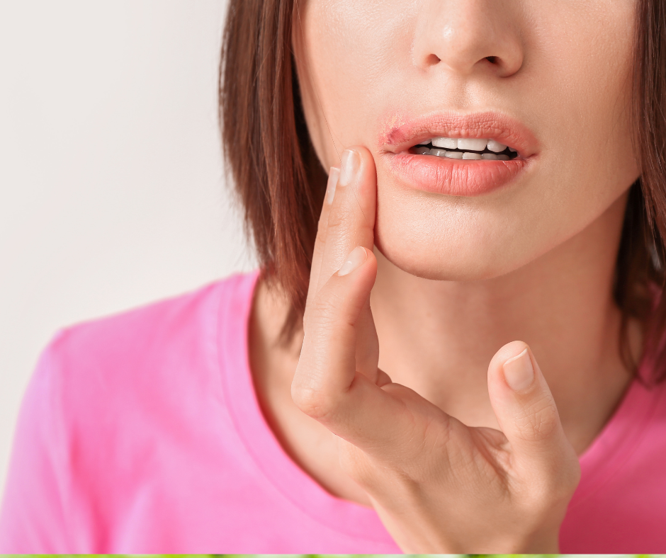 coconut oil to remedy cold sore
